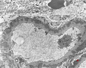 F,12y. | membranous glomerulopathy - lupus erythematodes st. V F,12y. | membranous glomerulopathy - lupus erythematodes st. V